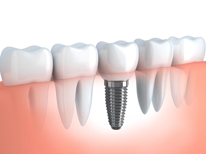 Dental Implants  North Augusta, SC 